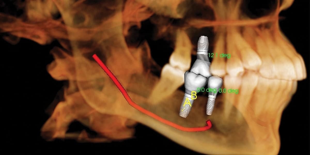 Dentist crafting a dental crown.